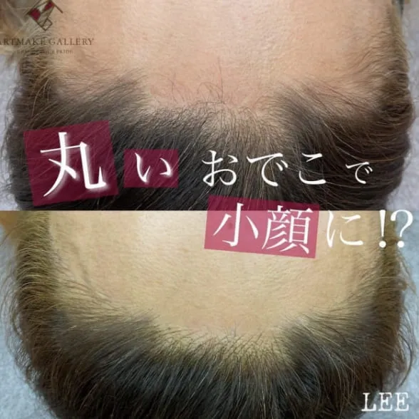 ヘアラインを整えて丸いおでこで小顔に！