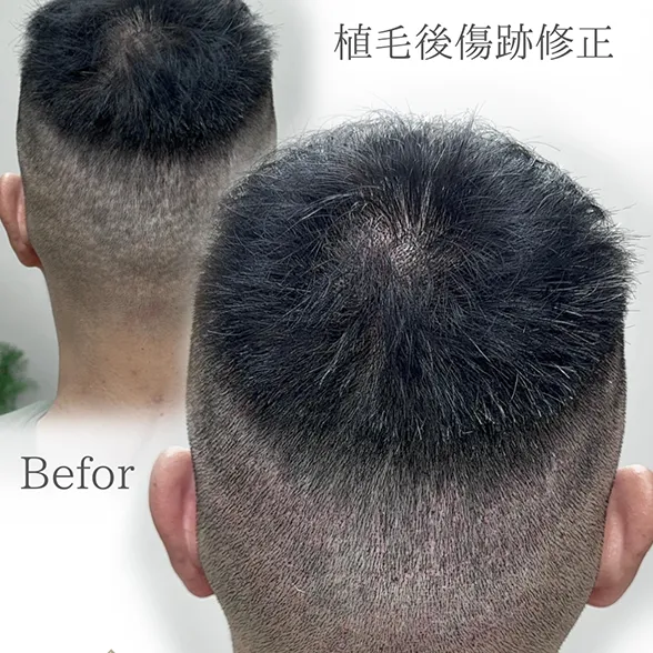 SMP／植毛部分
