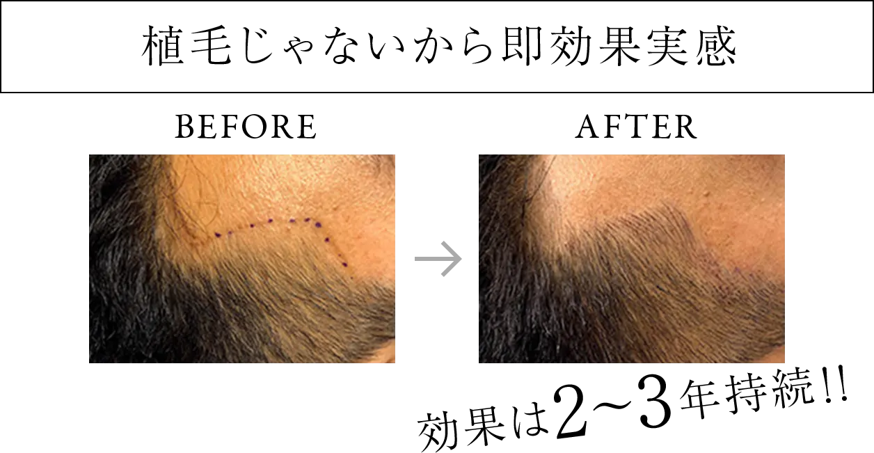 植毛じゃないから即効果実感