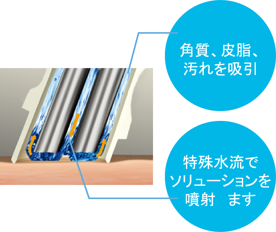 螺旋型チップ