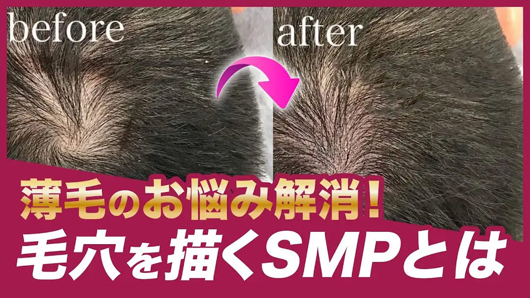 薄毛のお悩み解消！毛穴を描くSMPとは